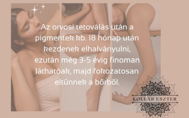 Az egyik kérdés, ami sokatokban felmerül  az orvosi tetoválással kapcsolatban az, hogy mennyire tartós?