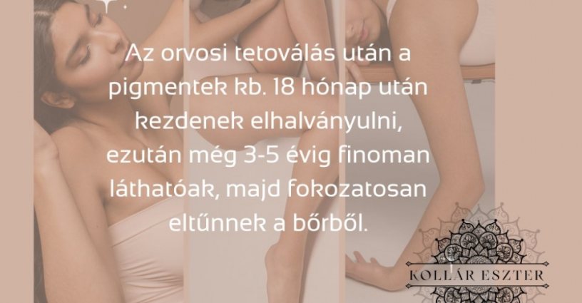 Az egyik kérdés, ami sokatokban felmerül az orvosi tetoválással kapcsolatban az, hogy mennyire tartós?
